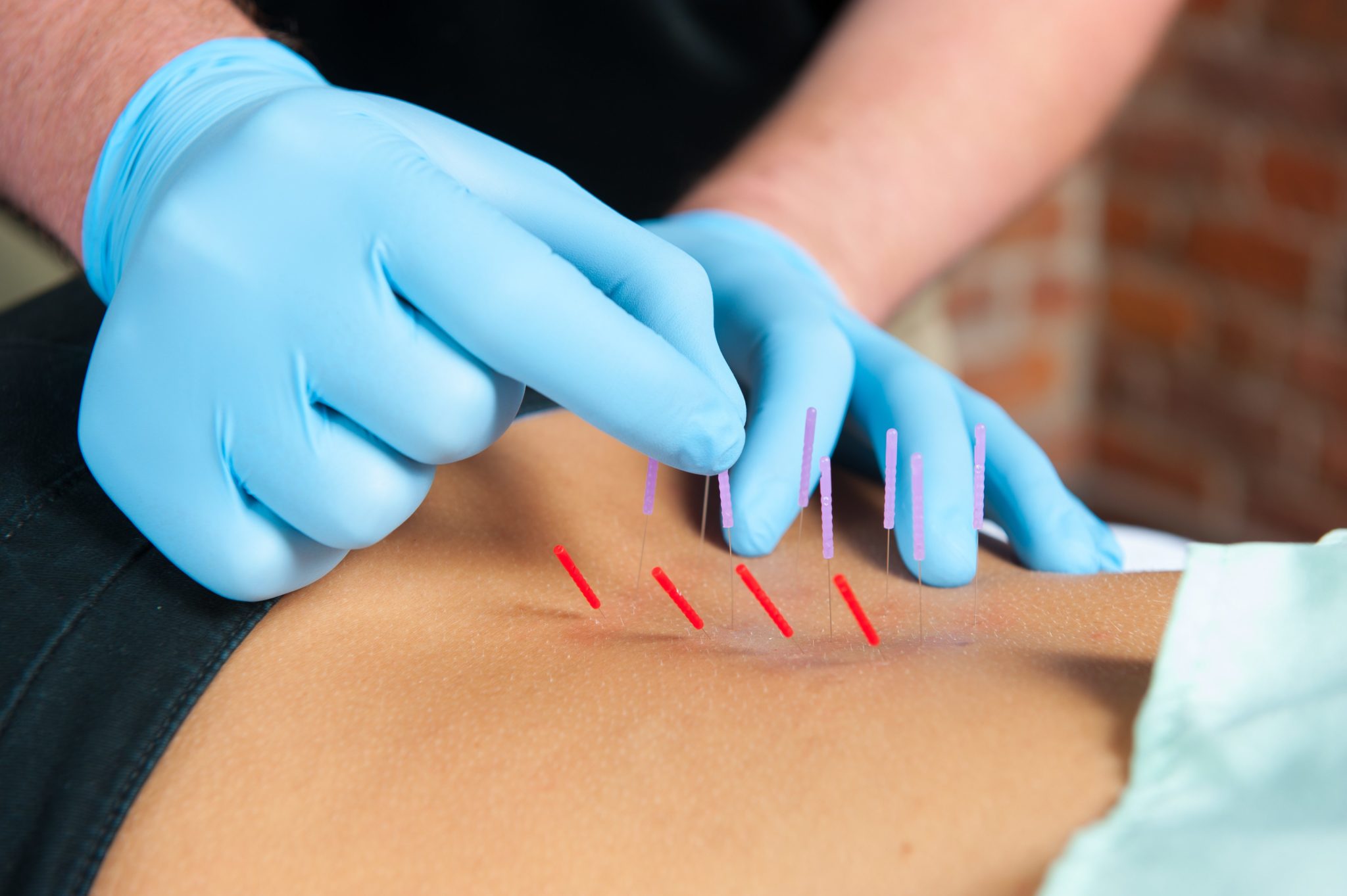 Dry Needling: soluzione semplice ed efficace per i punti dolorosi